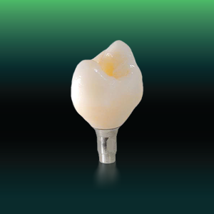 Emax on Implant restoration in dental lab workflow