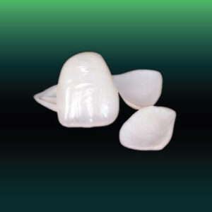 Emax Press Veneers - Premium Veneer Product
