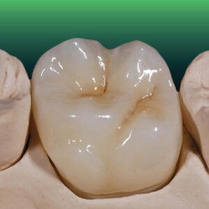 Zirconia Crowns in SGTD Dentallab production