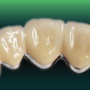 PFM Crowns in SGTD Dentallab production