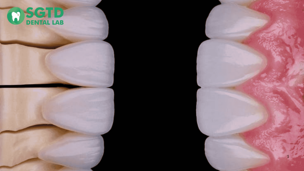 Dental Crown Fitting Procedure